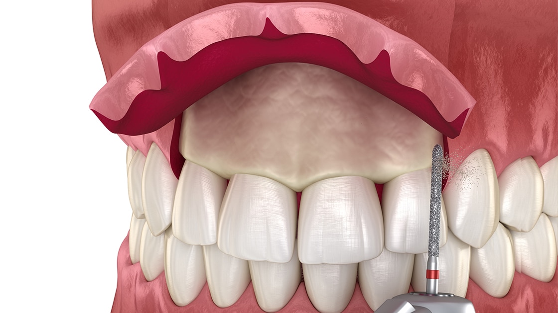 Periodontal Surgery Decorative Image of Patient