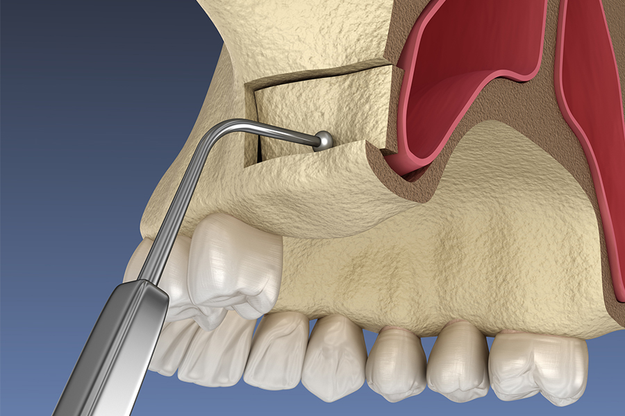 Sinus Lift Photo 1