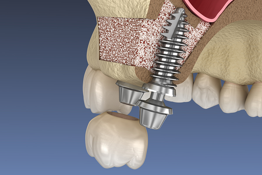 Sinus Lift Photo 3